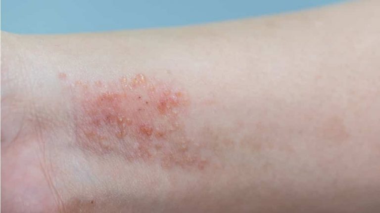 dermatite-atopica
